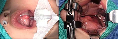 (a and b) Images of the soft palate mass present prior to the surgical removal; the mass is able to be viewed from the right soft palate that extends into the oropharynx.