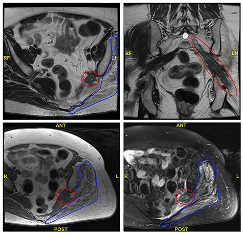Selected axial and coronal views from MRI pelvis showing a thickened and diseased left sciatic nerve (red circle) and atrophied left glutei with fatty infiltration (blue outline).