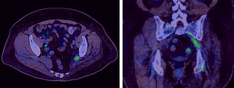 Selected axial and coronal slices from PET scan showing increased activity in the left sciatic nerve.