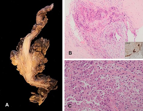 Histological specimen. (A) Main tumour dissected out shows extensive infiltration of the sciatic nerve. (B) Endometriotic focus within the tumour, endometrial stroma highlighted by immunohistochemical marker CD10. (C) The tumour showed features of endometrial carcinoma with glandular, papillary and solid pattern.