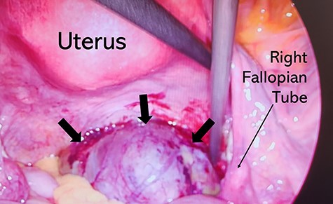 Intraoperative photograph demonstrating a large cystic lesion appearing to be contiguous with the right ovary.