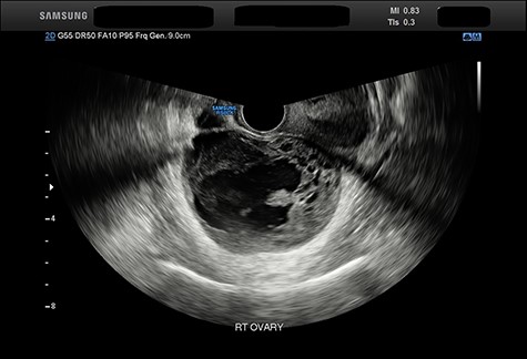 Abdominal ultrasound imaging demonstrating a heterogeneous solid and cystic lesion 75 × 53 mm.