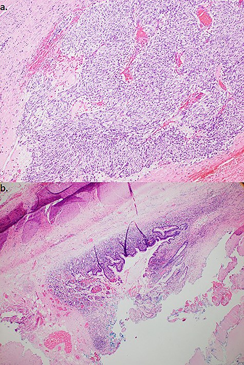 (a). Resected specimen (100×) stained with Haematoxylin and Eosin demonstrated epitheloid type cells composed in nests and (b). adjacent small bowel mucosa/muscularis. Immunohistochemistry (not shown)—10% tumour cells positive for Ki67, positive staining for CD117, negative staining for CD68, SMA and desmin, consistent with GIST.