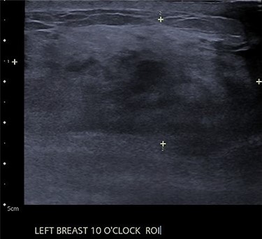 Left breast ultrasound of granulomatous mastitis.