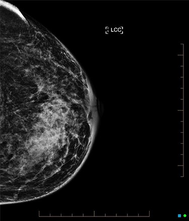 Left breast mammogram features of granulomatous mastitis.