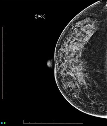 Mammogram of right breast carcinoma.