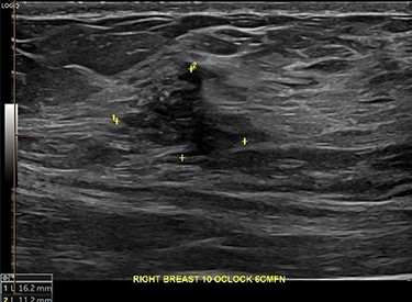 Right breast lesion visible on USS.