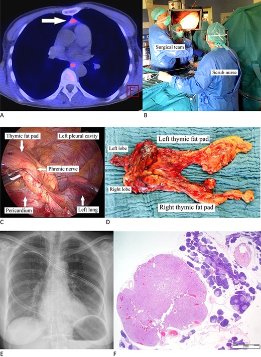 (A) Carbon-11-methionine PET-CT presenting a mediastinal ectopic PA (arrow). (B) Surgeon standing to the patient’s right with his assistant (camera operator) acting at his and the scrub nurse on the facing side. The video monitor is positioned towards anesthesia. (C) Thoracoscopic image: dissecting the pericardial fat pad alongside the phrenic nerve. (D) Resected specimen. (E) Postoperative X-ray. (F) PA is characterized by chief cells in acinar formations with a clear reduction in stromal fat content and focal clusters of oncocytic cells. Note the surrounding thymic tissue. (H&E stain, magnification ×1,25).