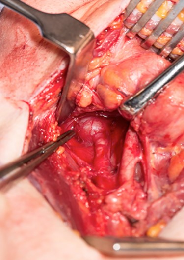 Internal carotid pseudoaneurysm as seen through a transcervical approach.