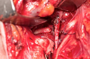 Elongated styloid seen through a transcervical approach.