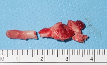 Excised styloid process measuring ~4 cm.