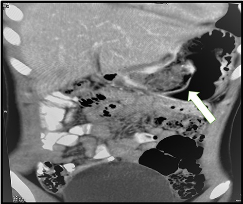 CT-scan abdomen showing the bezoar at the pylorus.