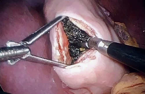 A 5-cm laparoscopic gastrostomy and extraction of a bezoar.