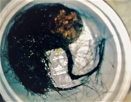 Bezoar specimen (15 cm) in length.