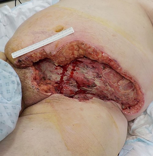 Post-surgical debridement.