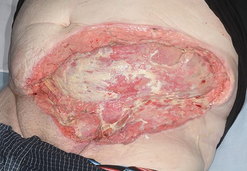 Abdominal wound (dressing removed) prior to discharge.