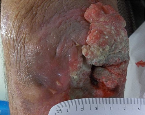 Posterior view of the left elbow at initial presentation. Raised, ulcerated, keratotic tumour with surrounding chronic inflammatory change to the skin. A sinus in the centre of the wound is present. Width of the wound is 5 cm.