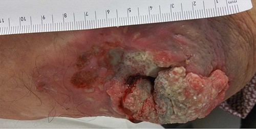 Posterolateral longitudinal view of the lesion at initial presentation. The proximal to distal dimension extends as far as 8 cm.