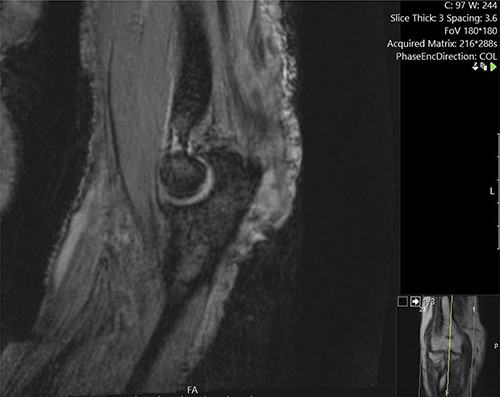 Sagittal MRI image demonstrating the invasion of the lesion into the, olecranon and distal triceps.