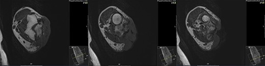 Cross-sectional MRI images demonstrating the position of the lesion and its infiltration into the joint space and deep tissues including the ulnar nerve.