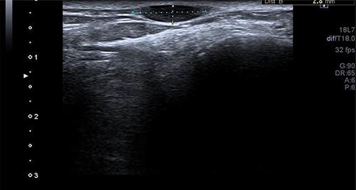 The US scan image of the right ankle posteriolateral aspect of Patient 1, which showed a well-defined ovoid hypo echoic lesion underneath the skin surface; measuring ~11 × 3 mm in diameter.