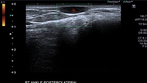 The Doppler US image of the right ankle posterolateral aspect of Patient 1, which shows mild internal vascularity.