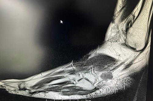 T1 MRI image of the soft tissue lesion over the lateral foot in Patient 2, which shows a lesion isointense to hypointense to the muscle.