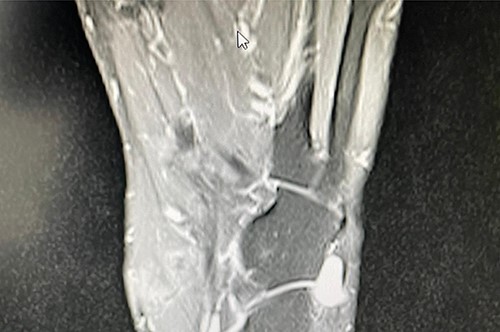 T2 axial MRI image of the soft tissue lesion over the lateral foot in Patient 2 showing a lesion which is heterogeneous and slightly hyperintense to the muscle.