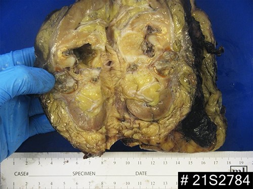 Macroscopic appearance of the left kidney demonstrating necrotic nodules, dilation of the pelvicalyceal system and extensive replacement of the renal parenchyma with fatty and cystic purulent material.