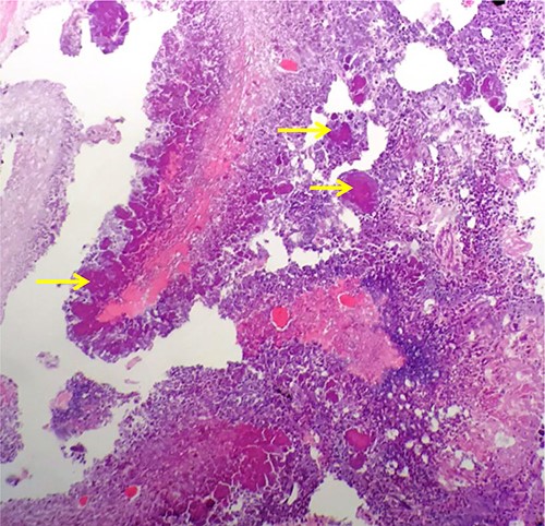 Haematoxylin and Eosin stained formalin-fixed paraffin embedded kidney showing rod-shaped branching microorganisms typical of Actinomyces, with adjacent purple–pink granules consistent with sulphur granules (arrows).