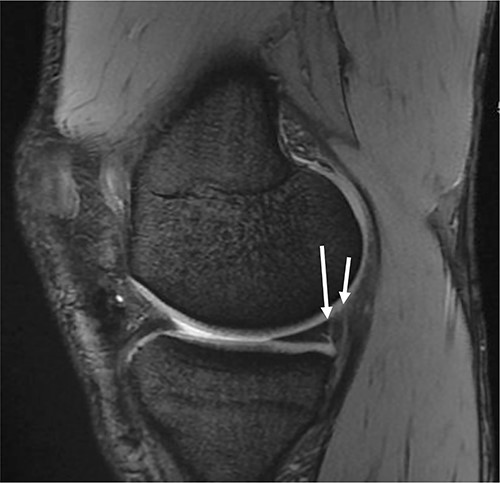 Sagittal magnetic resonance imaging of the knee. Gradient echo sequence image of the medial compartment of the knee demonstrating a suspicious double ramp lesion. The long arrow indicates the first ramp lesion, and the short arrow indicates the second ramp lesion