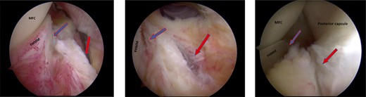 Trans-notch view of the posteromedial compartment of the left knee showing the blue arrow indicates the first lesion at the meniscosynovial junction of the red-red zone, and the red arrow indicates the second tear at the meniscocapsular attachment.