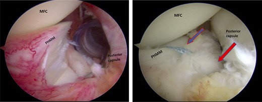 Trans-notch view of the posteromedial compartment of the left knee showing the surgical repair of the first tear. The blue arrow indicates the first lesion at the meniscosynovial junction in the red-red zone area. The red arrow shows the second tear at the meniscocapsular attachment. PHMM, posterior horn of the medial meniscus; MFC, medial femoral condyle