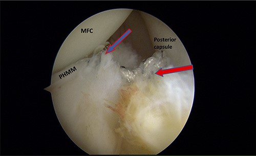 Trans-notch view of the postromedial compartment of the left knee showing the repair of both ramp lesion tears. The blue arrow indicates the repair of the first lesion at the meniscosynovial junction of the red-red zone area. The red arrow indicates the repaired second tear at the meniscocapsular attachment. PHMM, posterior horn of medial meniscus; MFC, medial femoral condyle