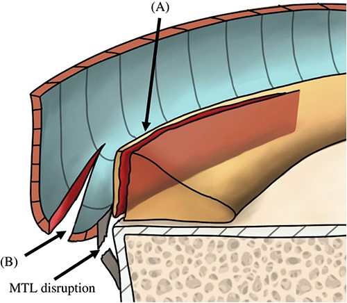 Illustration of the sagittal view of the posteromedial compartment showing the morphology of the tears. Panel (A) indicates the first tear, which was located at the PHMM of the meniscosynovial junction and was associated with disruption of the MTL. Panel (B) indicates the second tear, which was located at the meniscocapsular junction and was associated with disruption of the meniscocapsular attachment to the PHMM. PHMM, posterior horn of medial meniscus; MTL, meniscotibial ligament.