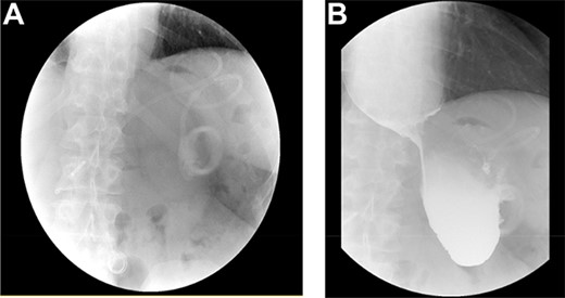 (A) LAGB more inferior and rotated consistent with band slippage; (B) marked distension of the oesophagus and contrast hold up at the level of the slipped band.
