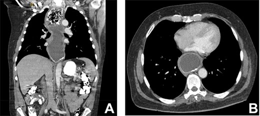 (A) CT coronal image of chest and abdomen demonstrating megaoesophagus secondary to the LAGB; (B) CT axial image of chest demonstrating megaoesophagus causing left atrial compression.
