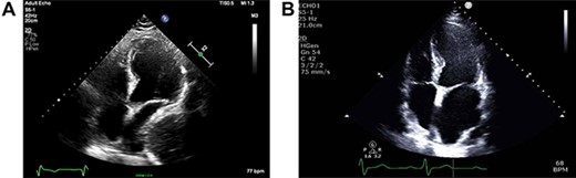 (A) ECHO showing left atrial compression from megaoesophagus during diastole; (B) ECHO showing normal-sized left atrium 3 months after band removal.