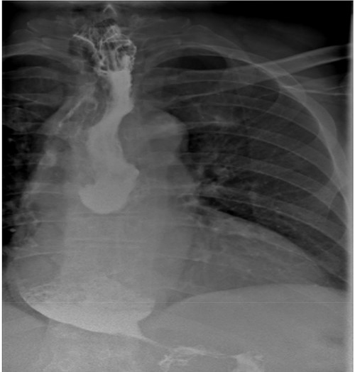 Barium contrast swallow study demonstrating ongoing oesophageal dilatation, however, free passage of contrast into the stomach.