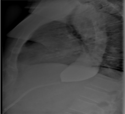Post-gastric sleeve barium contrast swallow study demonstrating ongoing oesophageal dilatation, but passage of contrast into remnant stomach.