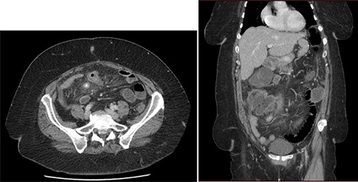Emergency CT: acute appendicitis with: intra-appendicular liquid, microstercoliths and peri-appendicular inflammation.