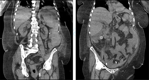 Splenic subcapsular hematoma and major hemoperitoneum.