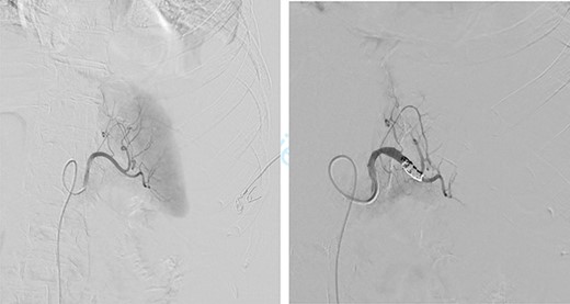 Embolization of splenic artery.