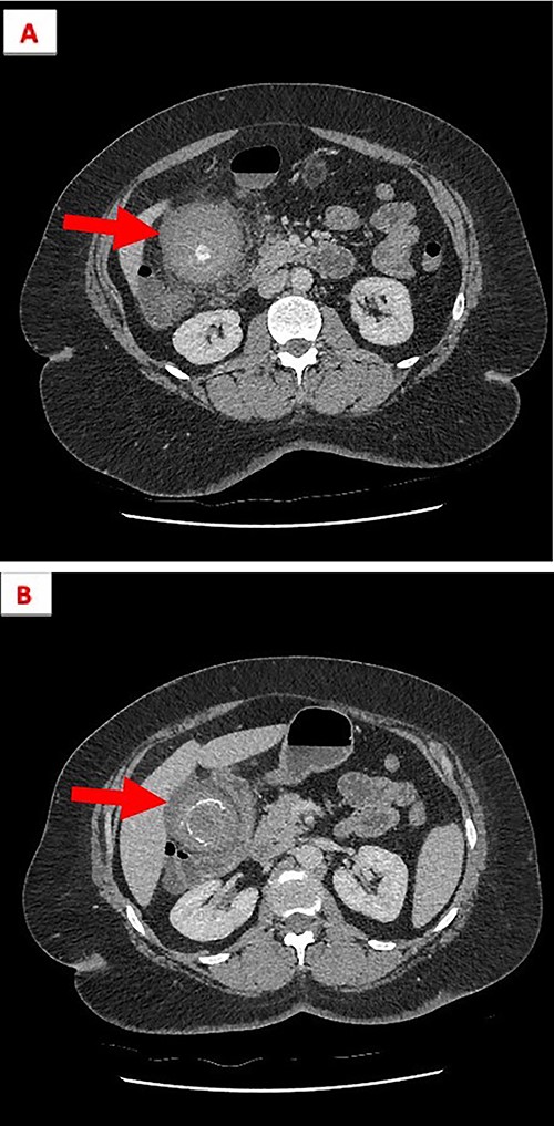 (A) The gallbladder contains numerous lamellated calculi and is distended with high-density fluid. (B) Gall bladder wall thickening and high-density fluid, both features are compatible with acute HC.