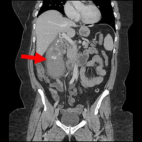 Coronal view of gall bladder with high-density fluid and calculi.