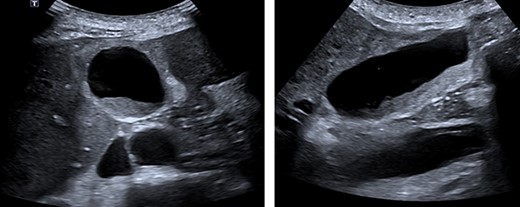 Abdominal ultrasound. A layer of mobile sludge and thickened gallbladder walls. Several liver lesions with mixed echogenicity were noted, several adjacent to the gallbladder fossa.