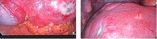 Extensive hepatic metastatic disease. An inelastic liver edge and inflamed gallbladder was encountered with adhesions.
