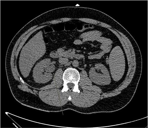 An initial CT KUB showed mild diffuse dilatation of the right renal pelvis (as indicated by the arrow).