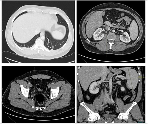 A CT scan of the abdomen with IV contrast showed atelactic changes in the lung bases (top left), reactive hilar nodes (top right), a distended right ureter all the way down to the vesicoureteric junction surrounded by fat stranding (bottom left) and splenomegaly (bottom right).