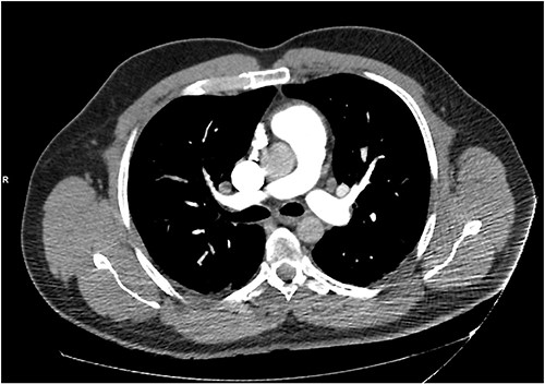 A CT pulmonary angiography was done to exclude pulmonary embolism. Only dependent bilateral changes in the lower lobes and signs of mild pulmonary venous congestion were noted.